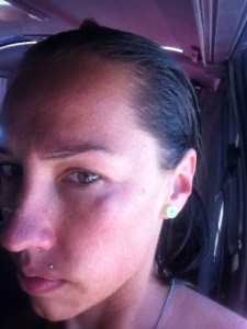 Wategos surfing injury - black eye from a fellow board rider!